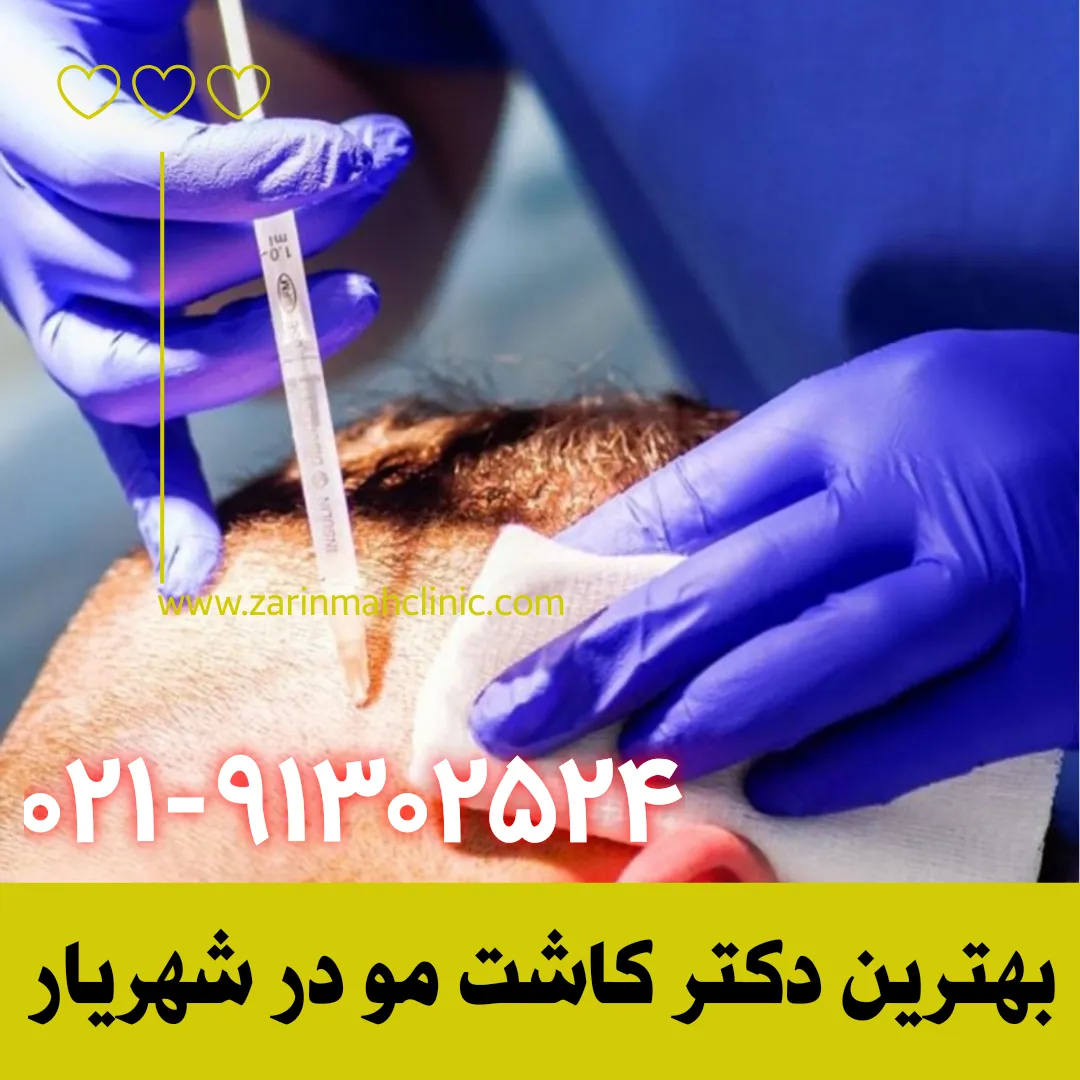بهترین دکتر کاشت مو در شهریار