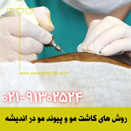 انواع روش های کاشت مو و پیوند در اندیشه