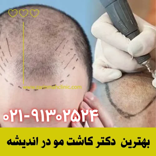 بهترین دکتر کاشت مو در اندیشه
