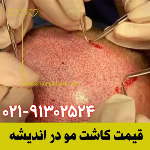 قیمت کاشت مو در اندیشه