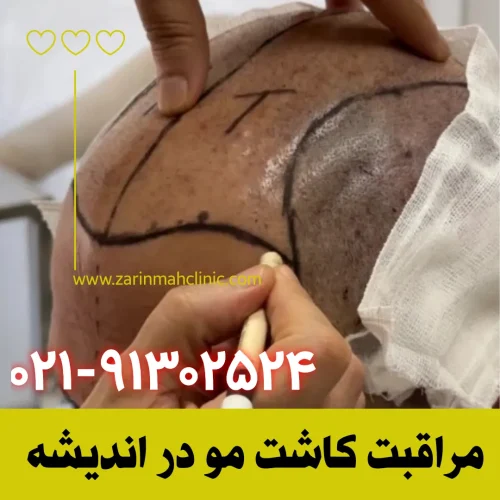 مراقبت کاشت مو در اندیشه