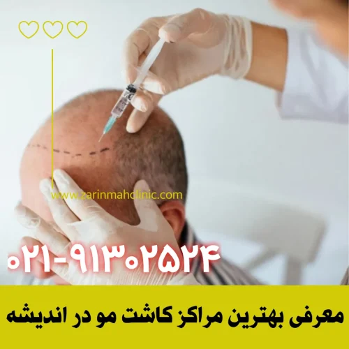 معرفی بهترین مراکز کاشت مو در اندیشه