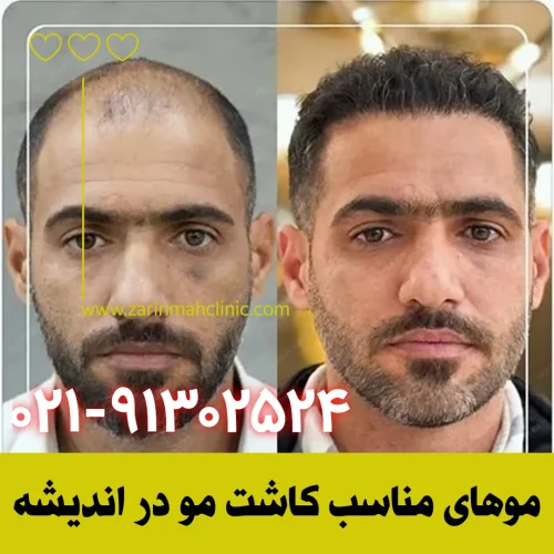 چه موهایی برای کاشت مو مناسب است؟