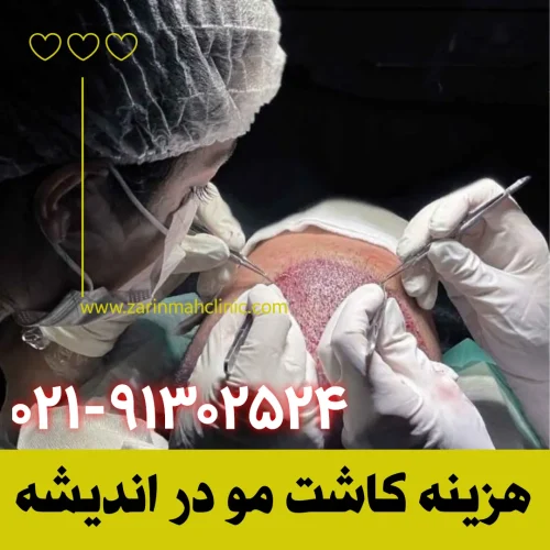 هزینه کاشت مو در اندیشه