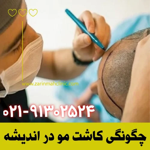 چگونگی کاشت مو در اندیشه