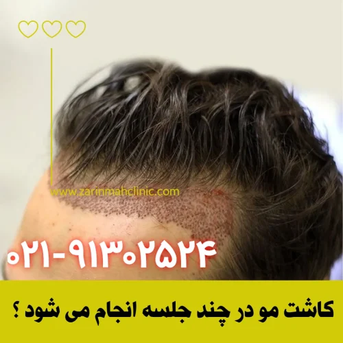 کاشت مو در چند جلسه انجام می شود